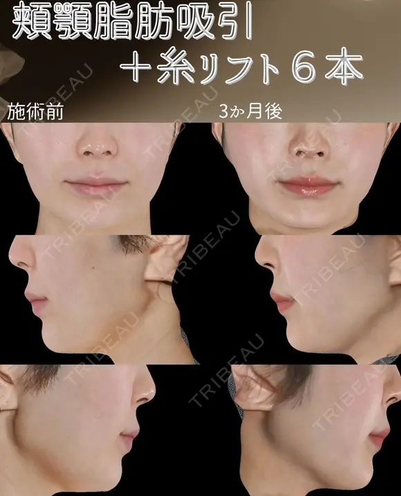サクションリフト 90日後 メイン用