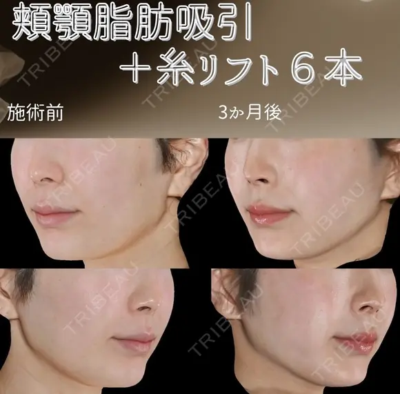 サクションリフト 90日後 メイン用