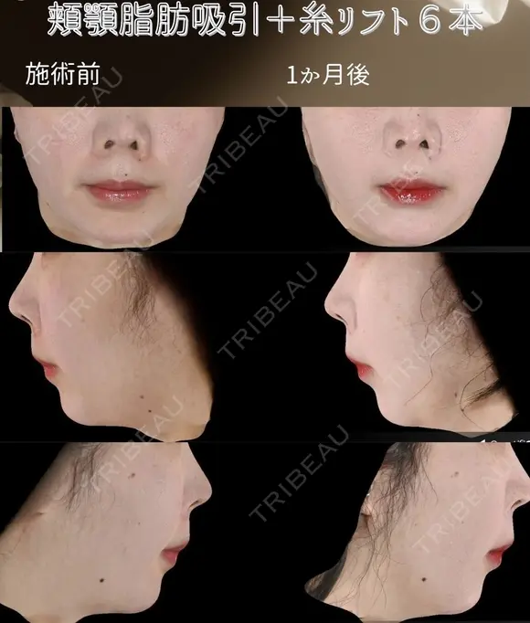 サクションリフト before画像 メイン用