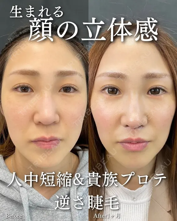 人中短縮　貴族プロテーゼ　逆さまつ毛修正 after画像 メイン用
