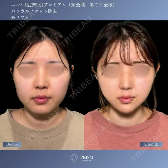 顔脂肪吸引・バッカルファット・糸リフト✨引き締めて整える 小顔トータルデザイン before画像 メイン用