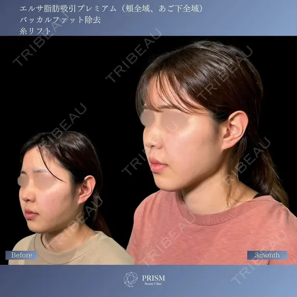 顔脂肪吸引・バッカルファット・糸リフト✨引き締めて整える 小顔トータルデザイン 30日後 メイン用