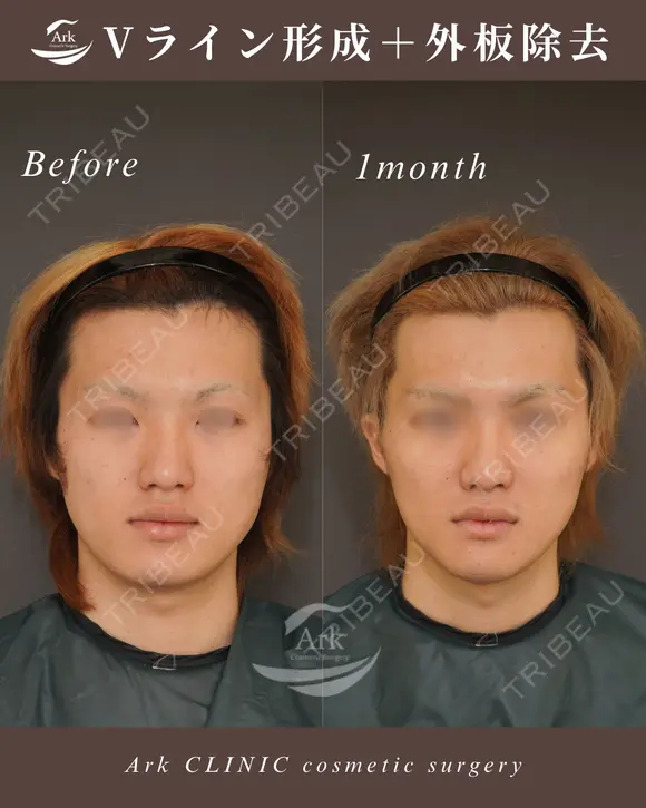 Vライン形成＋外板除去 before画像 メイン用
