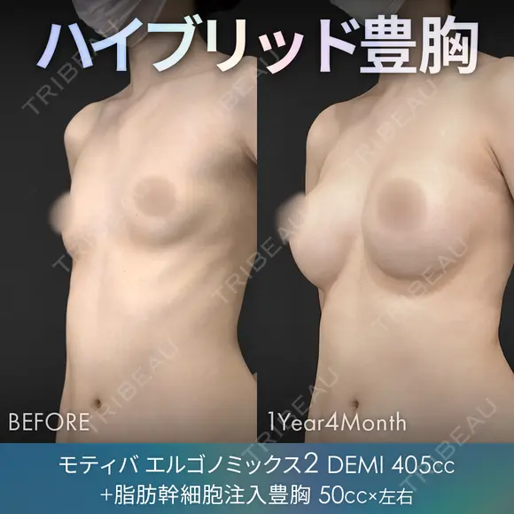 ハイブリッド豊胸（シリコンバッグ豊胸＋脂肪幹細胞注入豊胸） before画像 メイン用