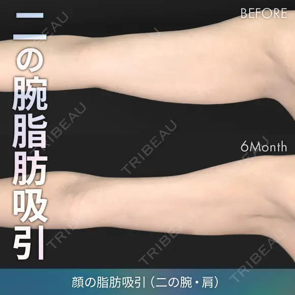 脂肪吸引（二の腕・肩） before画像 メイン用