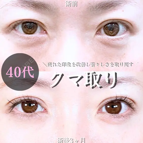 目の下のクマ取り/脂肪注入(目の下・ゴルゴライン) 90日後 メイン用