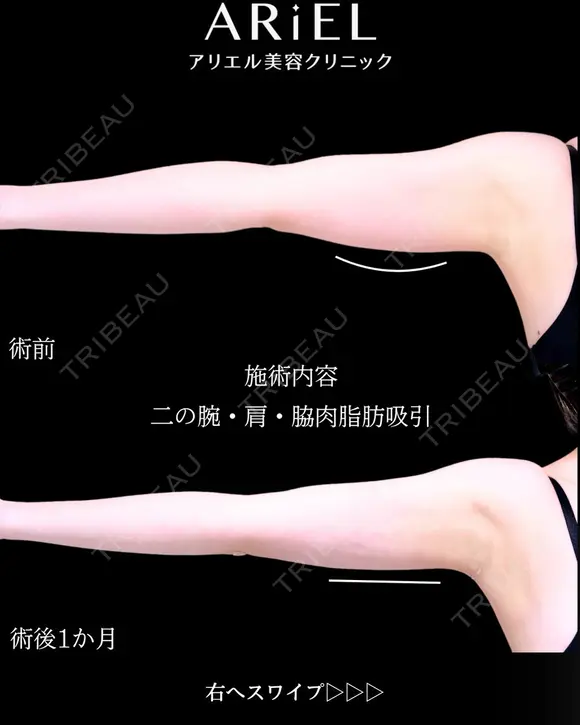 二の腕　肩　脇肉　脂肪吸引 before画像 メイン用