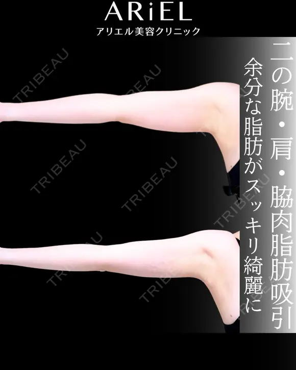 二の腕　肩　脇肉　脂肪吸引 30日後 メイン用