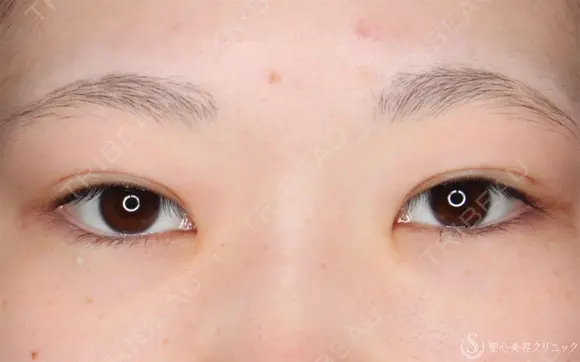 【10代女性・自然な二重に】二重全切開法（6ヶ月後） before画像 メイン用