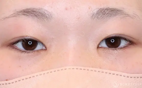 【10代女性・自然な二重に】二重全切開法（6ヶ月後） 180日後 メイン用