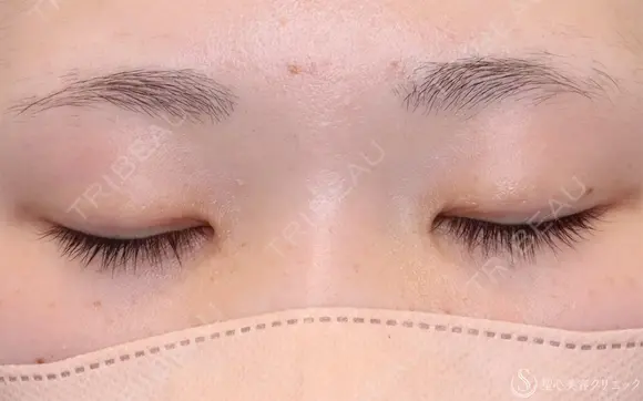 【10代女性・自然な二重に】二重全切開法（6ヶ月後） 180日後 メイン用