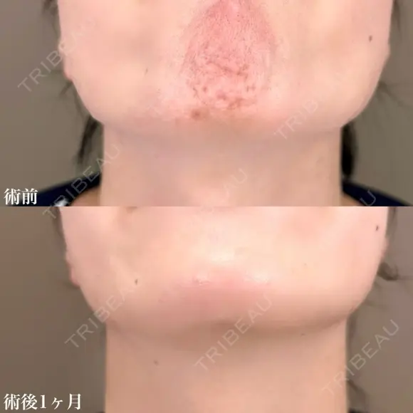 顎ボツリヌストキシン注射 after画像 メイン用