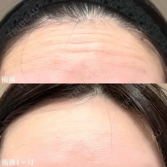 額ボツリヌストキシン注射 after画像 メイン用