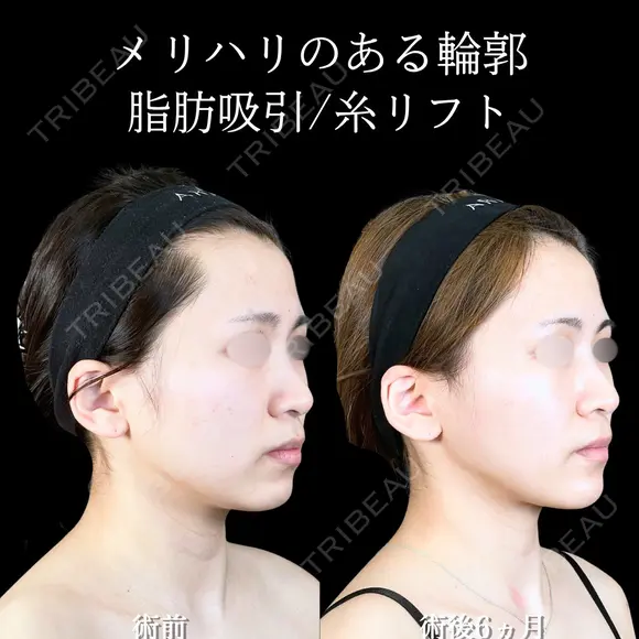 頬・頬骨上・顎下脂肪吸引 /バッカルファット/ジョールファット/糸リフト/エラ・顎ボトックス／顎ヒアルロン酸  180日後 メイン用