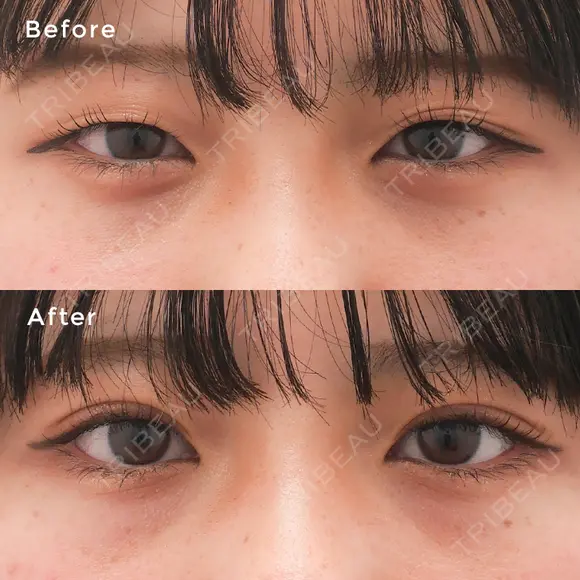 埋没法プレミアム after画像 メイン用