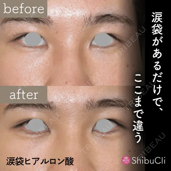 涙袋ヒアルロン酸 after画像 メイン用