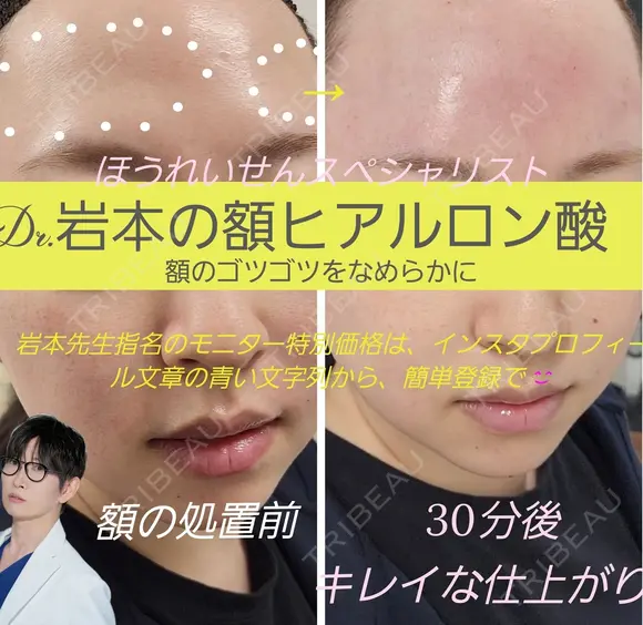 額ヒアルロン酸 before画像 メイン用