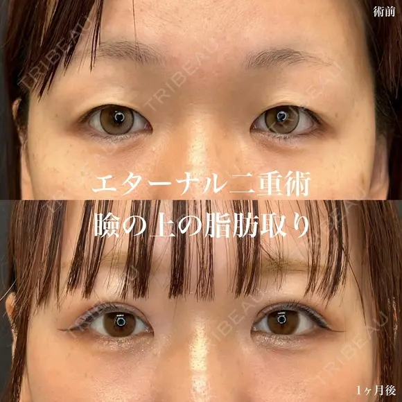 二重埋没（エターナル二重術）+瞼の上の脂肪取り after画像 メイン用