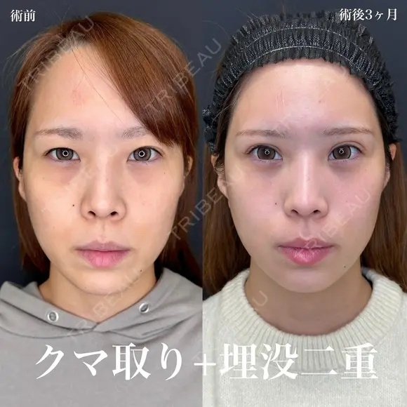 二重埋没（ルラループ二重術）+目の下のふくらみ取り（プラチナ）+脂肪注入（目の下～ゴルゴライン）ナノリッチ加工 before画像 メイン用