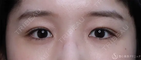 【20代女性・二重】マイクロメソッド3点（1ヶ月後） 30日後 メイン用