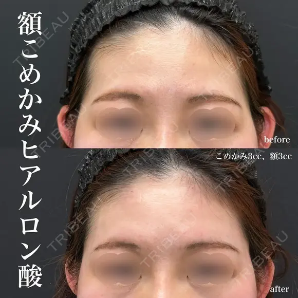 額こめかみヒアルロン酸（ボリフト４㏄+ボリューマ１㏄+ボルベラ１cc） before画像 メイン用