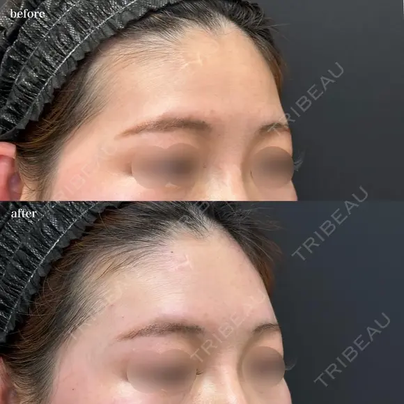 額こめかみヒアルロン酸（ボリフト４㏄+ボリューマ１㏄+ボルベラ１cc） after画像 メイン用