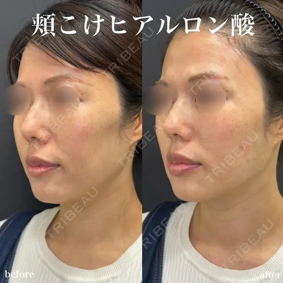 ハートシェイプ（ボリューマ２㏄）、ボトックスリフト（フェイスライン）、口角ボトックス before画像 メイン用