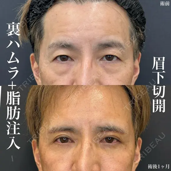 裏ハムラ+脂肪注入(目の下〜ゴルゴライン、額こめかみ、頬コケ) +眉下切開(ナチュラルロング) before画像 メイン用