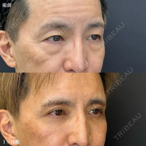 裏ハムラ+脂肪注入(目の下〜ゴルゴライン、額こめかみ、頬コケ) +眉下切開(ナチュラルロング) after画像 メイン用