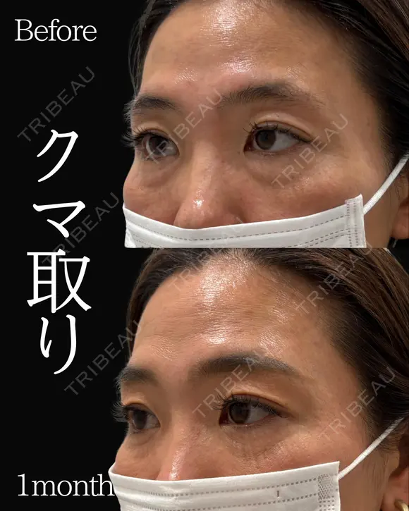 岩切医師による🔥クマ取り🔥 before画像 メイン用