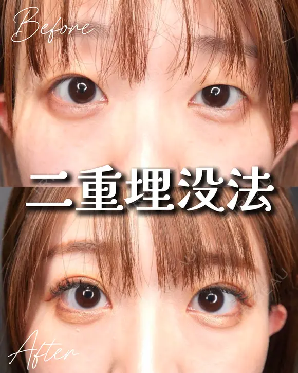 目元くっきり👀二重埋没 before画像 メイン用