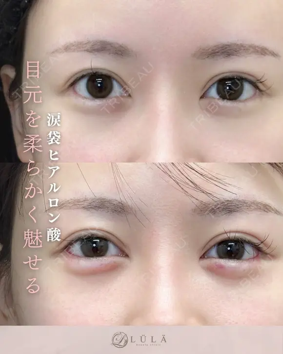 涙袋（ボルベラ） after画像 メイン用