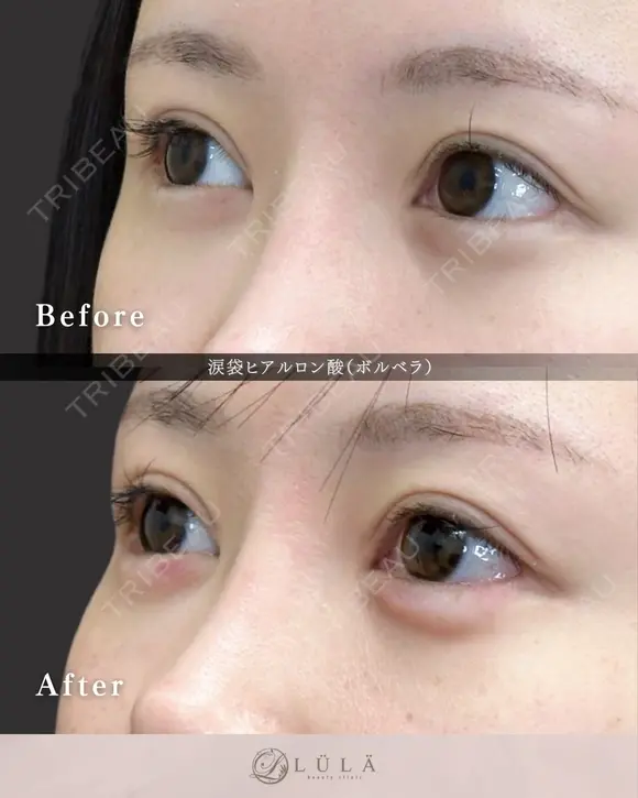 涙袋（ボルベラ） after画像 メイン用