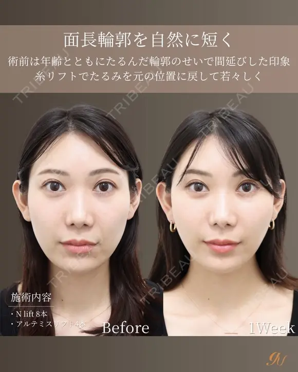 30代 | 口周り改善リフト before画像 メイン用