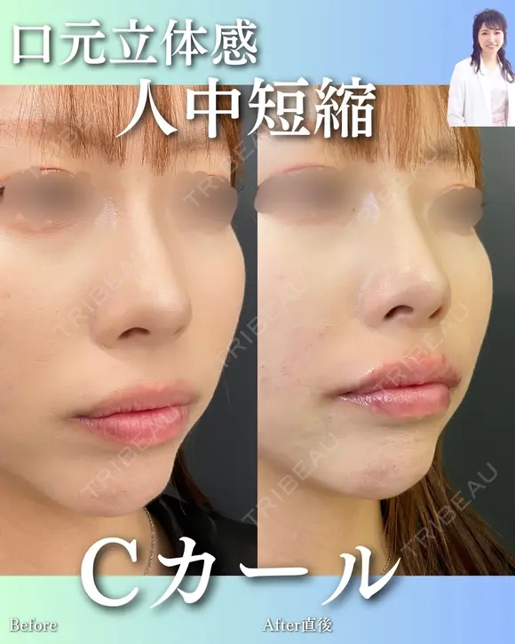 Cカールリップ before画像 メイン用
