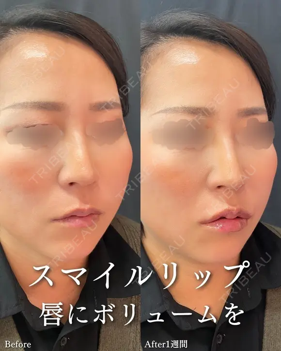 スマイルリップ after画像 メイン用