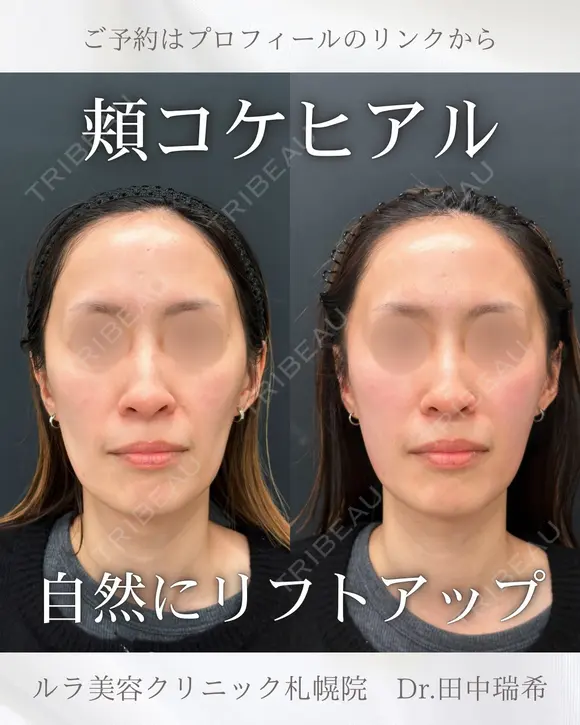 ハートシェイプ before画像 メイン用