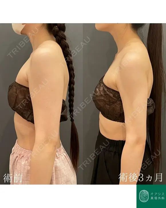 カリカリボディを目指す🌴コンプリート脂肪吸引【上腕全周～お背中一部】形成外科専門医がご対応 before画像 メイン用