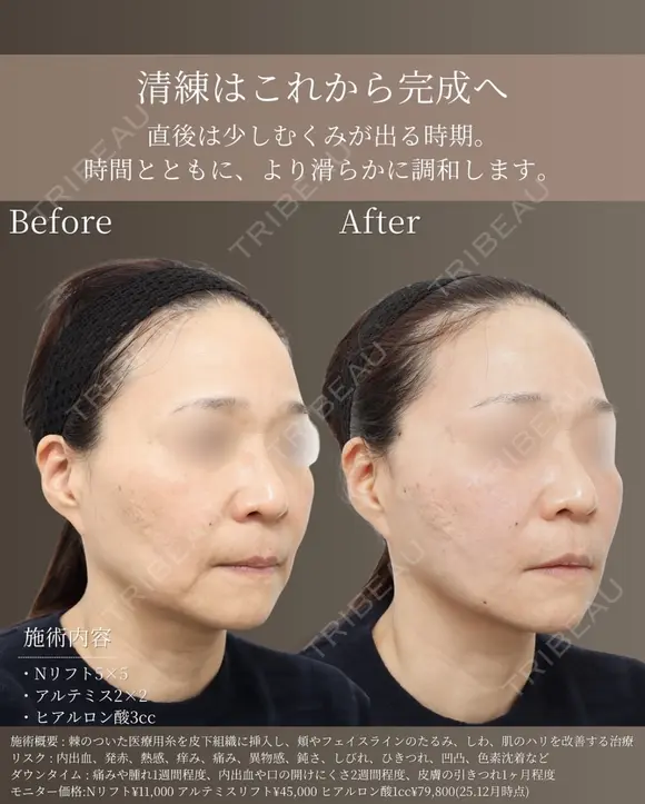 50代 | フェイスライン改善リフト before画像 メイン用