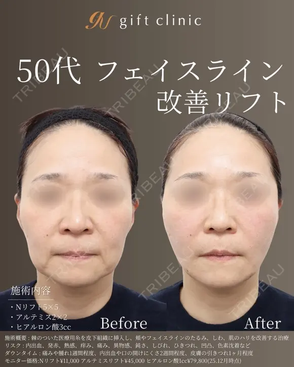 50代 | フェイスライン改善リフト after画像 メイン用