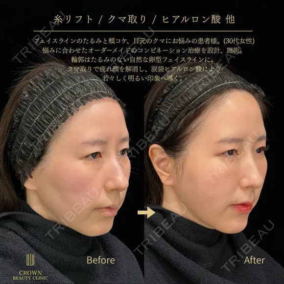 小顔輪郭整形・クマ治療 before画像 メイン用
