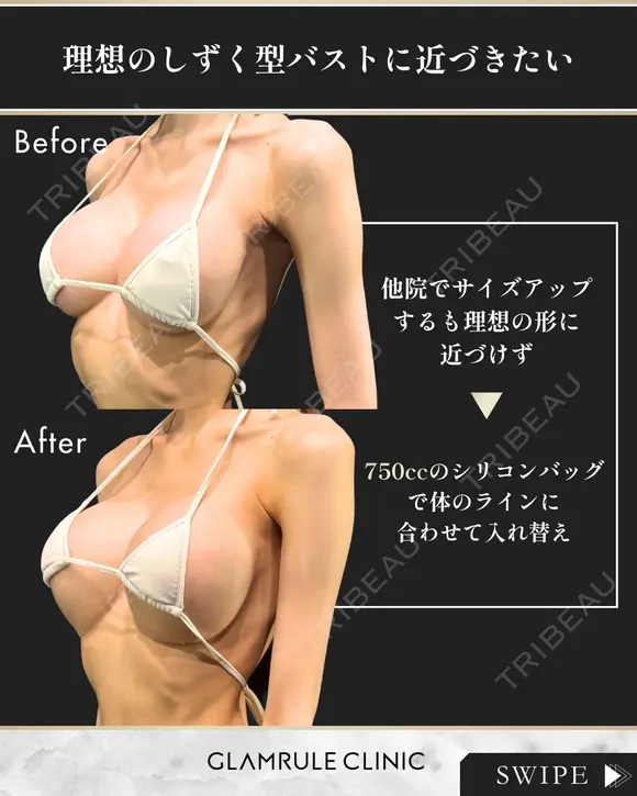 シリコンバッグ豊胸(他院修正) before画像 メイン用