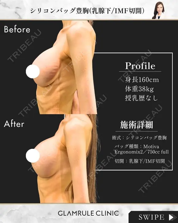 シリコンバッグ豊胸(他院修正) after画像 メイン用