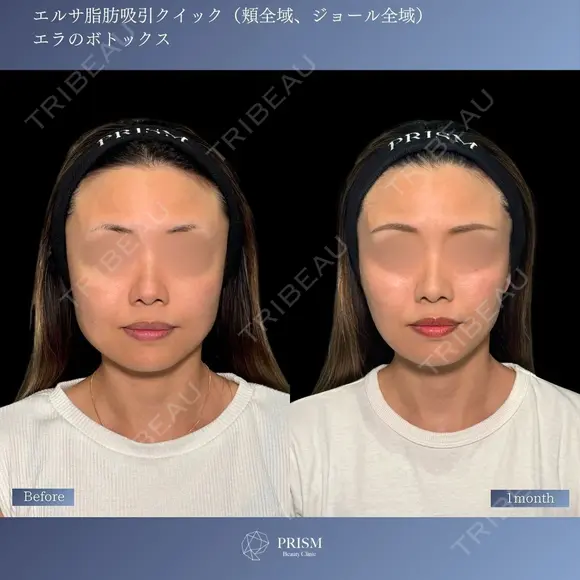 すっきりフェイスラインへ⭐︎顔脂肪吸引×エラボトックス before画像 メイン用
