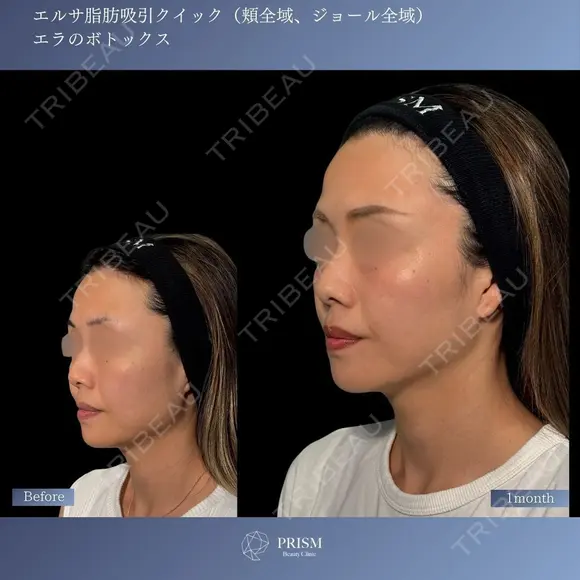すっきりフェイスラインへ⭐︎顔脂肪吸引×エラボトックス 30日後 メイン用