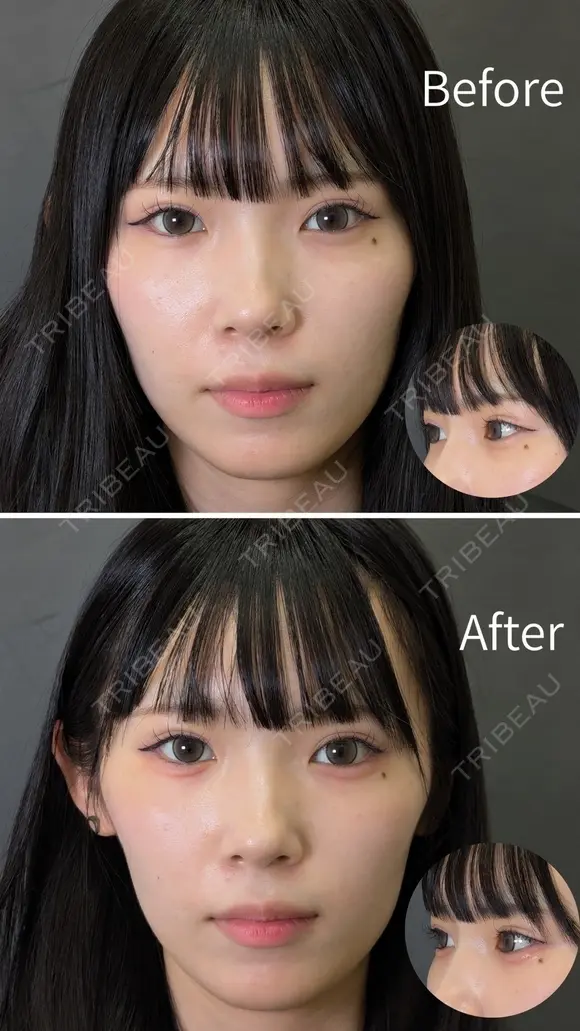 【涙袋】ヒアルロン酸注入 before画像 メイン用