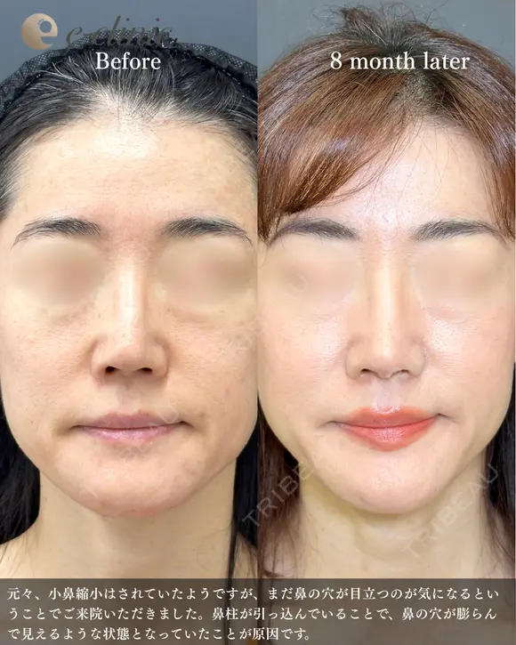 鼻柱下降（単独症例） before画像 メイン用