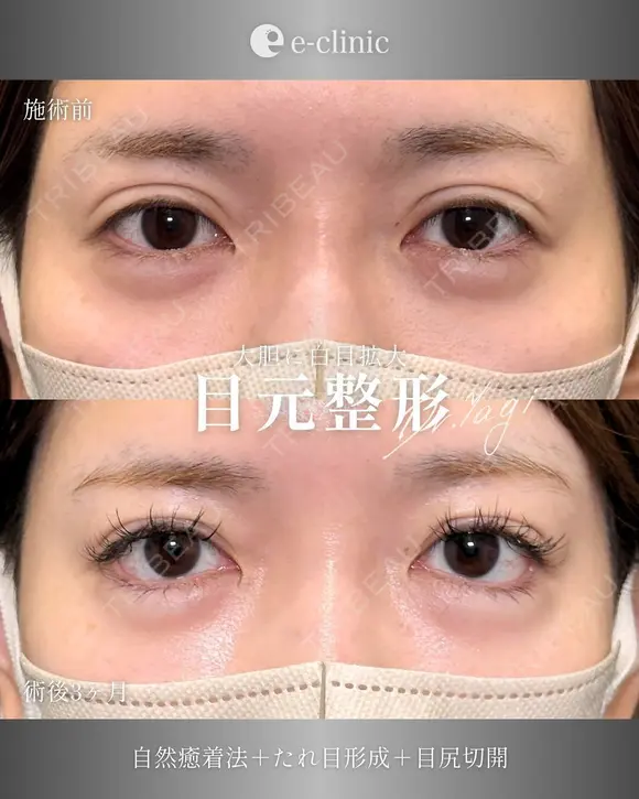 目元整形（拡大） after画像 メイン用