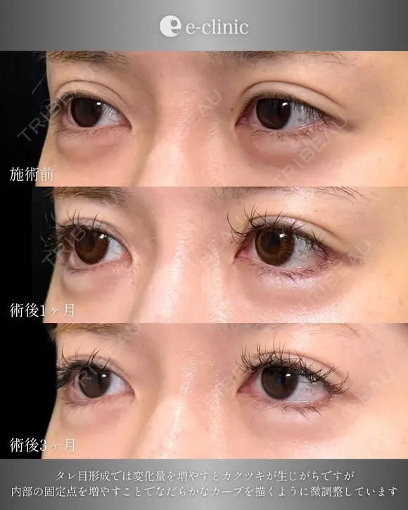 目元整形（拡大） before画像 メイン用
