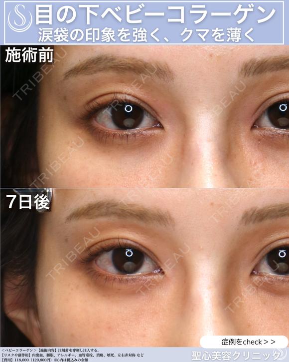 【20代女性】目の下のクマを薄く：ベビーコラーゲン 7日後 メイン用